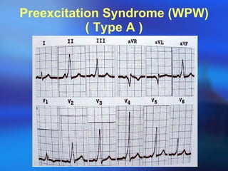 Preexcitation Syndrome (WPW) ( Type A ) 