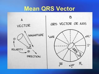 Mean QRS Vector 