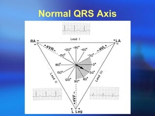 Normal QRS Axis 