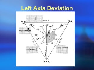 Left Axis Deviation 