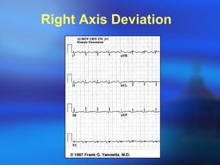 Right Axis Deviation  