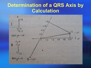 Determination of a QRS Axis by Calculation 