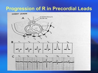 Progression of R in Precordial Leads 