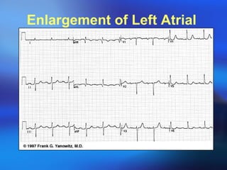 Enlargement of Left Atrial  