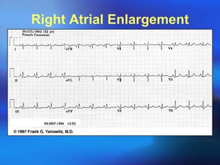Right Atrial Enlargement 