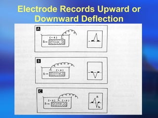 Electrode Records Upward or Downward Deflection 