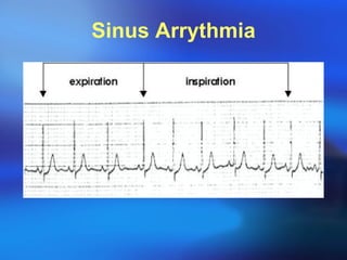 Sinus Arrythmia 
