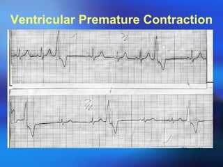 Ventricular Premature Contraction 