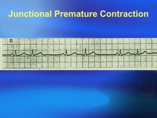 Junctional Premature Contraction 