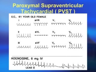 Paroxymal Supraventricular Tachycardial ( PVST ) 