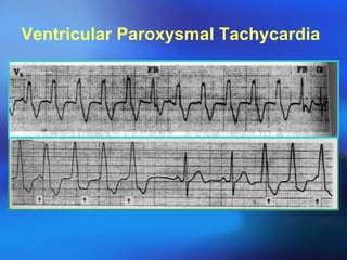 Ventricular Paroxysmal Tachycardia 