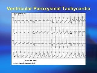Ventricular Paroxysmal Tachycardia 