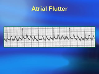 Atrial Flutter 