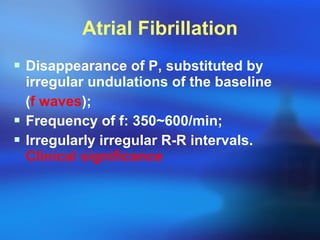 Atrial Fibrillation Disappearance of P,  substituted by irregular undulations of the baseline  ( f waves ); Frequency of f: 350~600/min; Irregularly irregular R-R intervals.  Clinical significance 