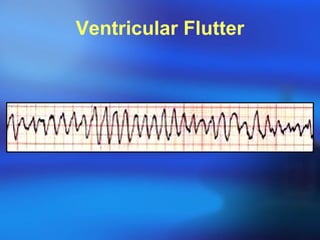 Ventricular Flutter 