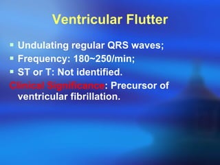 Ventricular Flutter Undulating regular QRS waves; Frequency: 180~250/min; ST or T: Not identified. Clinical Significance : Precursor of ventricular fibrillation. 