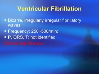Ventricular Fibrillation Bizarre, irregularly irregular fibrillatory waves; Frequency: 250~500/min; P, QRS, T: not identified Clinical significance: 