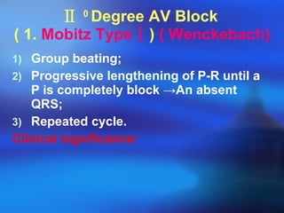 Ⅱ   0  Degree AV Block  ( 1.  Mobitz Type Ⅰ )  ( Wenckebach) Group beating; Progressive lengthening of P-R until a P is completely block  ->An absent QRS; Repeated cycle. Clinical significance: 