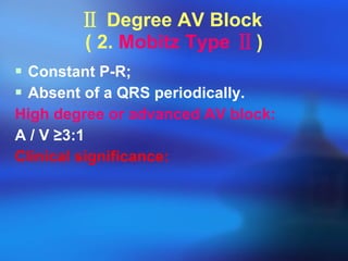 Ⅱ   Degree AV Block  ( 2.  Mobitz Type  Ⅱ ) Constant P-R; Absent of a QRS periodically. High degree or advanced AV block:   A / V  ≥ 3:1 Clinical significance: 