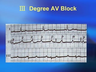 Ⅲ  Degree AV Block 