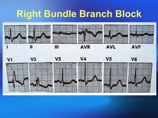 Right Bundle Branch Block 