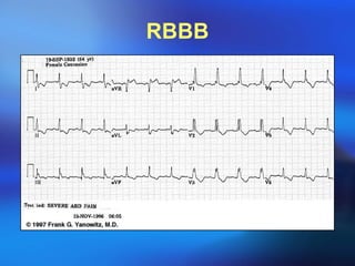 RBBB 