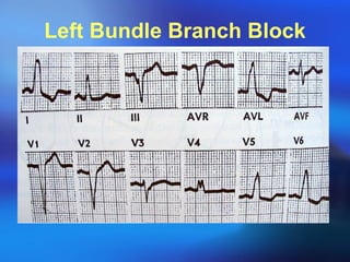 Left Bundle Branch Block 