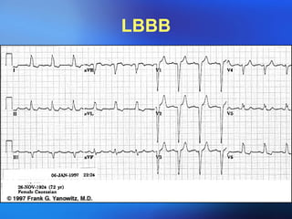 LBBB 