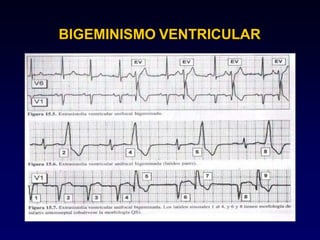 BIGEMINISMO VENTRICULAR
 