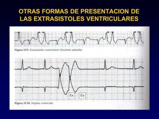 OTRAS FORMAS DE PRESENTACION DE
LAS EXTRASISTOLES VENTRICULARES
 