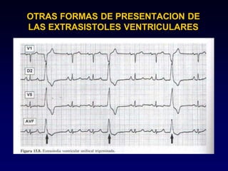 OTRAS FORMAS DE PRESENTACION DE
LAS EXTRASISTOLES VENTRICULARES
 