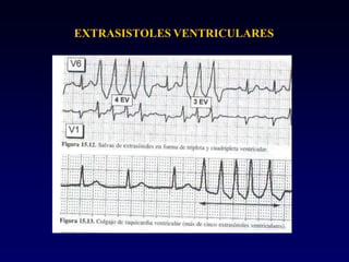 EXTRASISTOLES VENTRICULARES
 