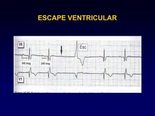 ESCAPE VENTRICULAR
 