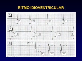 RITMO IDIOVENTRICULAR
 