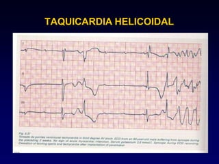 TAQUICARDIA HELICOIDAL
 