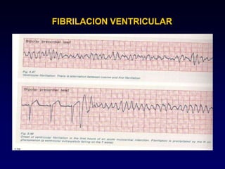 FIBRILACION VENTRICULAR
 