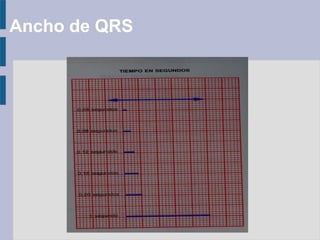 Ancho de QRS
 