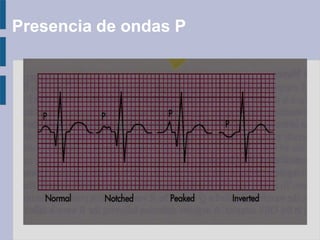 Presencia de ondas P
 