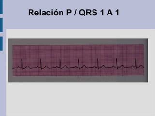 Relación P / QRS 1 A 1
 