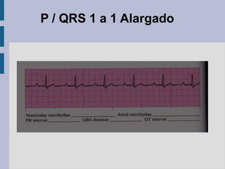 P / QRS 1 a 1 Alargado
 