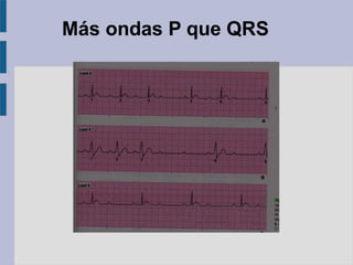 Más ondas P que QRS
 