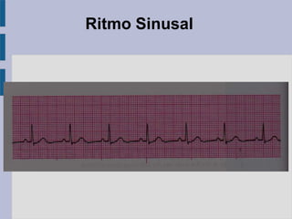 Ritmo Sinusal
 