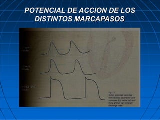 POTENCIAL DE ACCION DE LOS
DISTINTOS MARCAPASOS
 