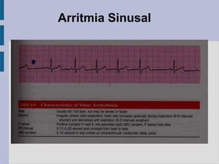 Arritmia Sinusal
 