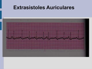 Extrasistoles Auriculares
 
