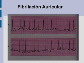 Fibrilación Auricular
 