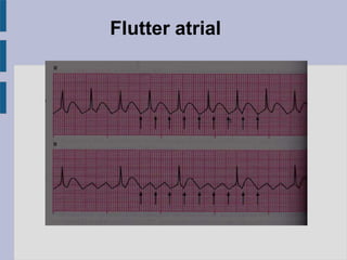 Flutter atrial
 