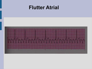 Flutter Atrial
 