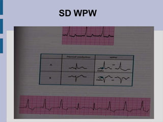 SD WPW
 