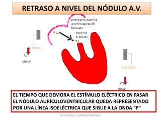 DR. RAMÓN E. GUARDIOLA BRIZUELA
EL TIEMPO QUE DEMORA EL ESTÍMULO ELÉCTRICO EN PASAR
EL NÓDULO AURÍCULOVENTRICULAR QUEDA REPRESENTADO
POR UNA LÍNEA ISOELÉCTRICA QUE SIGUE A LA ONDA “P”
RETRASO A NIVEL DEL NÓDULO A.V.
 
